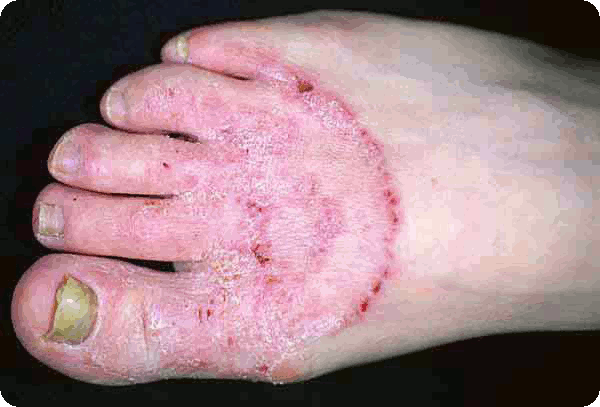 Dermatophyte (tinea) infections - UpToDate